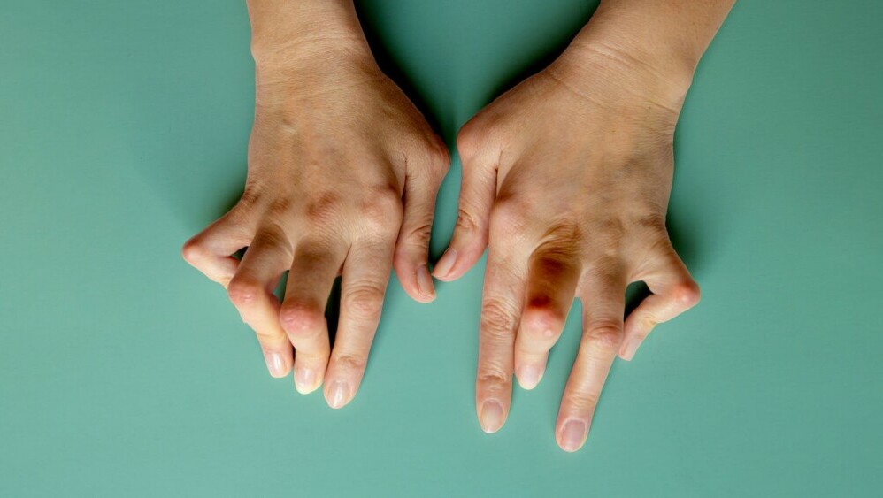 natural remedies for rheumatoid arthritis